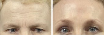 Brow Lift