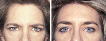 Brow Lift