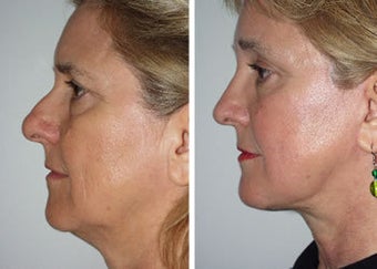 Brow Lift