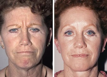 Brow Lift