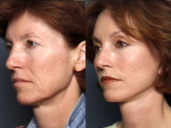 Brow Lift