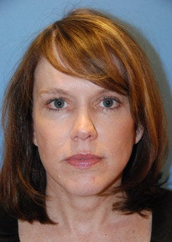 Face Lift, Neck Lift, Brow Lift