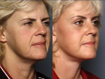 Brow Lift