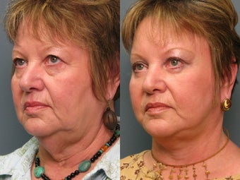 Brow Lift