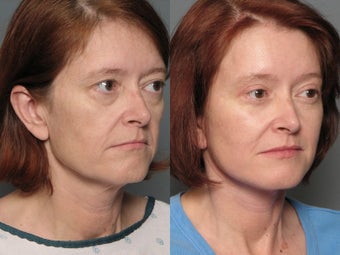 Brow Lift
