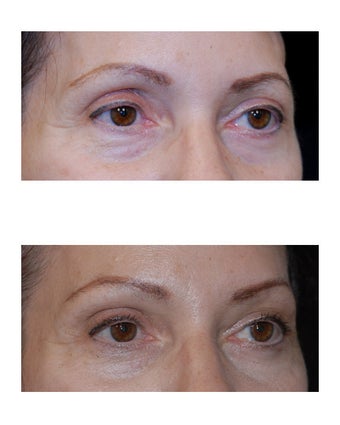 Lateral Brow Lift