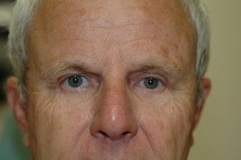 Brow lift