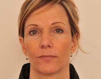 Endoscopic Browlift and Upper Eyelids