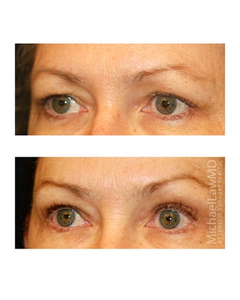 Brow lift