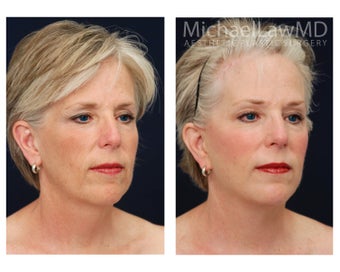 Facial Rejuvenation - Brow Lift