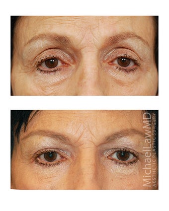Facial Rejuvenation - Brow Lift