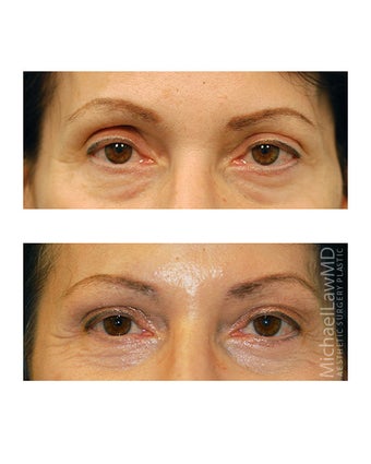 Facial Rejuvenation - Brow Lift