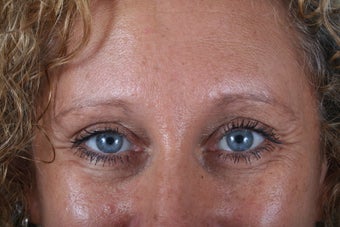 Endoscopic browlift, upper and lower blepharoplasty (eyelids)