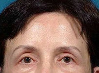 Brow Lift