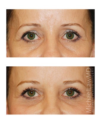 Brow Lift