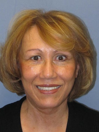Brow Lift