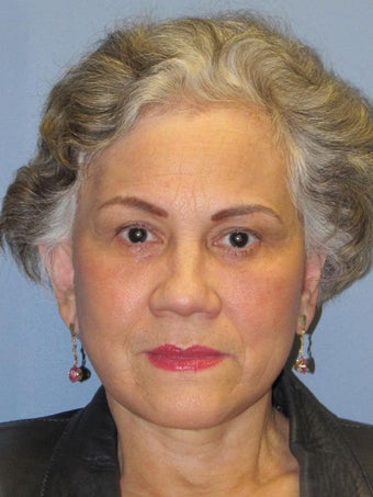 Brow Lift
