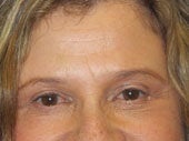 Brow Lift