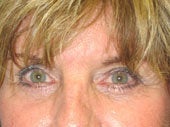 Brow Lift