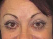 Brow Lift