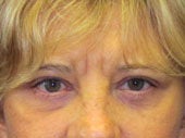 Brow Lift