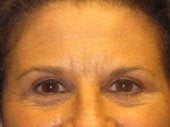 Brow Lift