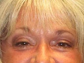 Brow Lift