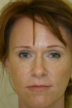 Brow Lift with Upper and Lower Blepharoplasty