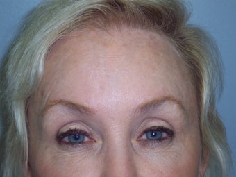 Brow lift