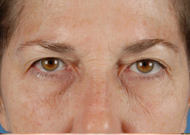 Browlift and Upper/Lower Eyes