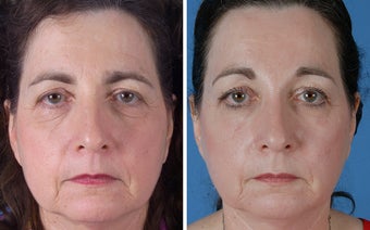Endoscopic Browlift and Upper and Lower Eyelid Surgery