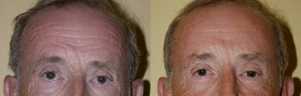 BrowLift 