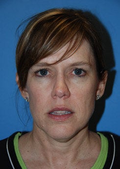 Face Lift, Neck Lift, Brow Lift
