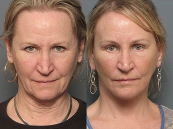 Brow Lift