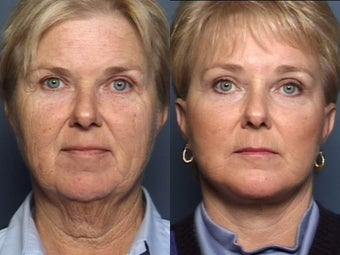 Brow Lift