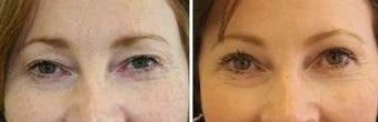 51 years old / upper lid blepharoplasty and endoscopic brow lift.