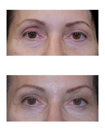 Lateral Brow Lift