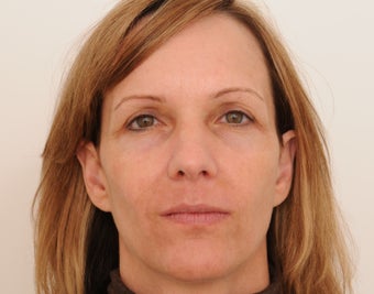 Endoscopic Browlift and Upper Eyelids