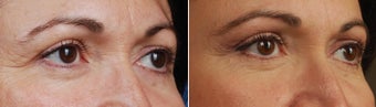 revision upper blepharoplasty-temporal brow lift