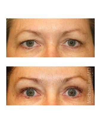 Brow lift