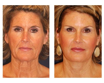 Facial Rejuvenation