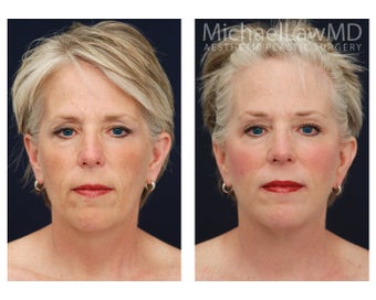Facial Rejuvenation - Brow Lift