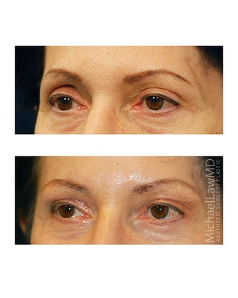 Facial Rejuvenation - Brow Lift