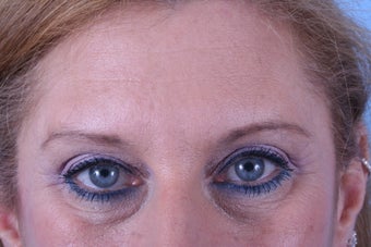 Endoscopic browlift, upper and lower blepharoplasty (eyelids)