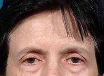 Brow Lift