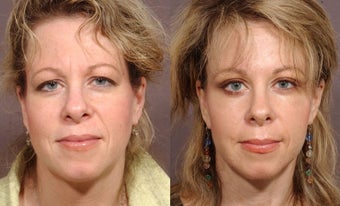 Brow Lift
