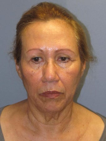 Brow Lift