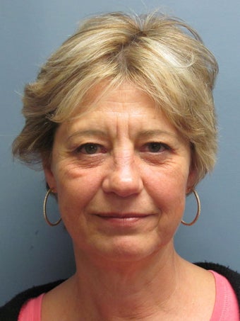 Brow Lift, Eyelid Lift