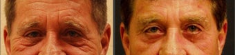 Brow Lift