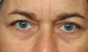 Browlift